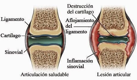 Artritis Reumatoide