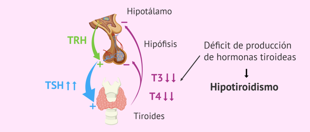 Hipotiroidismo