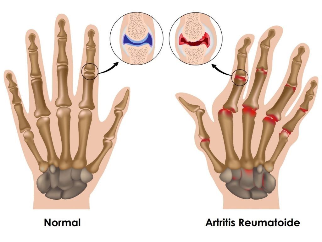 Mano Normal Y Mano Con Artritis Reumatoide